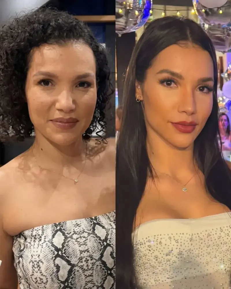 Caso real de Full Face feminino — paciente Instituto Leal à Face, antes e depois com a Dra. Beatriz Leal