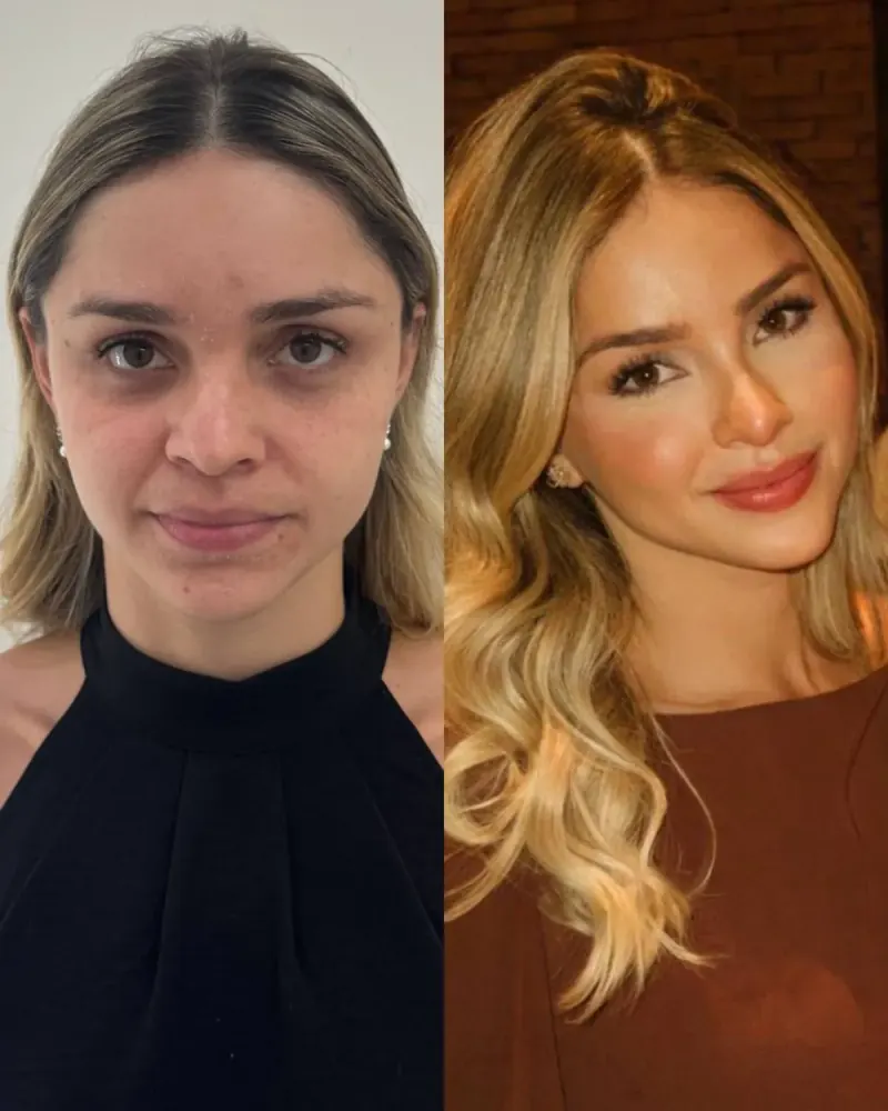 Caso real de Full Face feminino — harmonização facial completa, Instituto Leal à Face