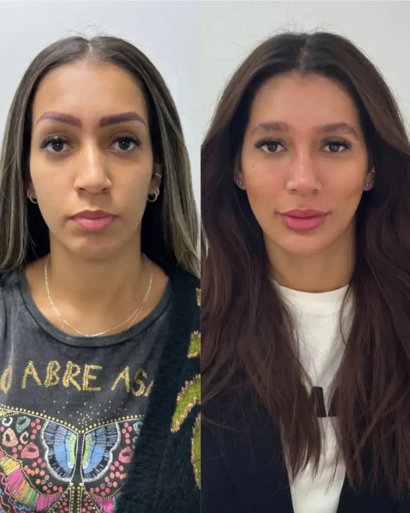 Caso real de Full Face feminino — antes e depois Dra. Beatriz Leal, Barra da Tijuca