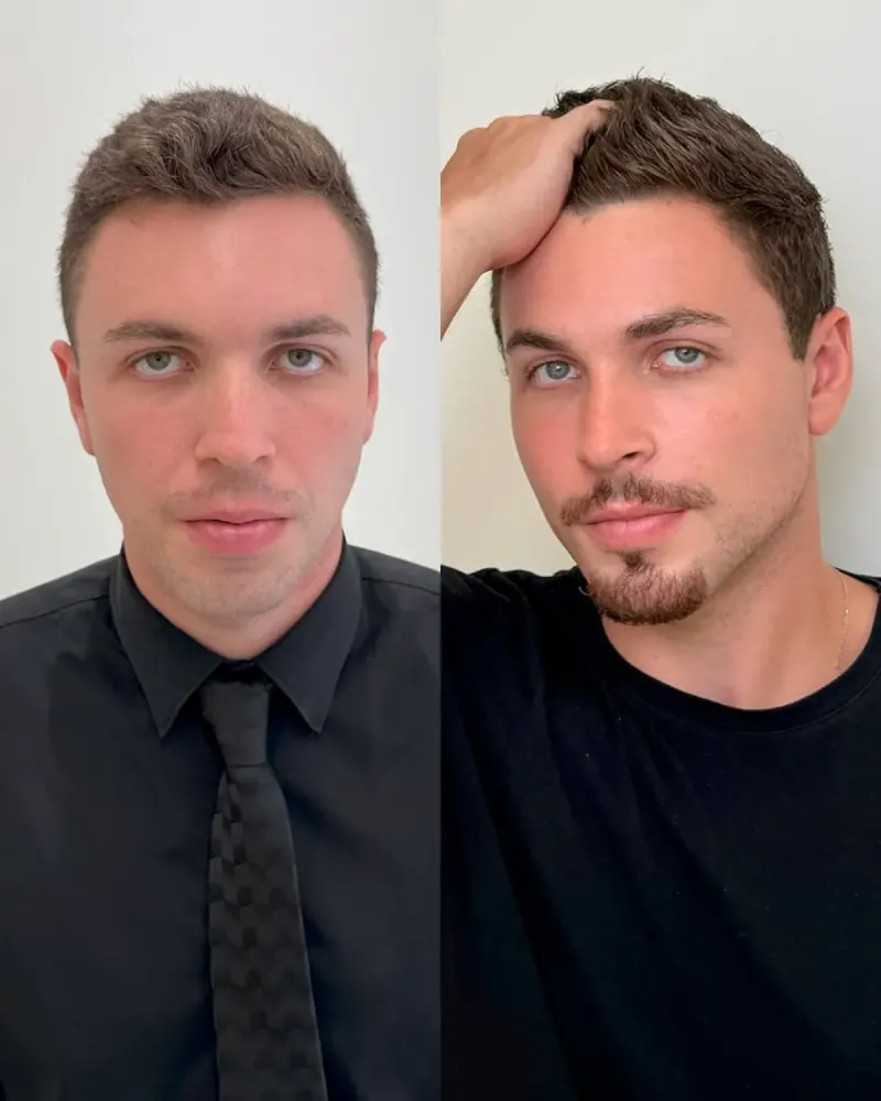 Caso real de Full Face masculino — paciente Instituto Leal à Face, harmonização facial completa para homens