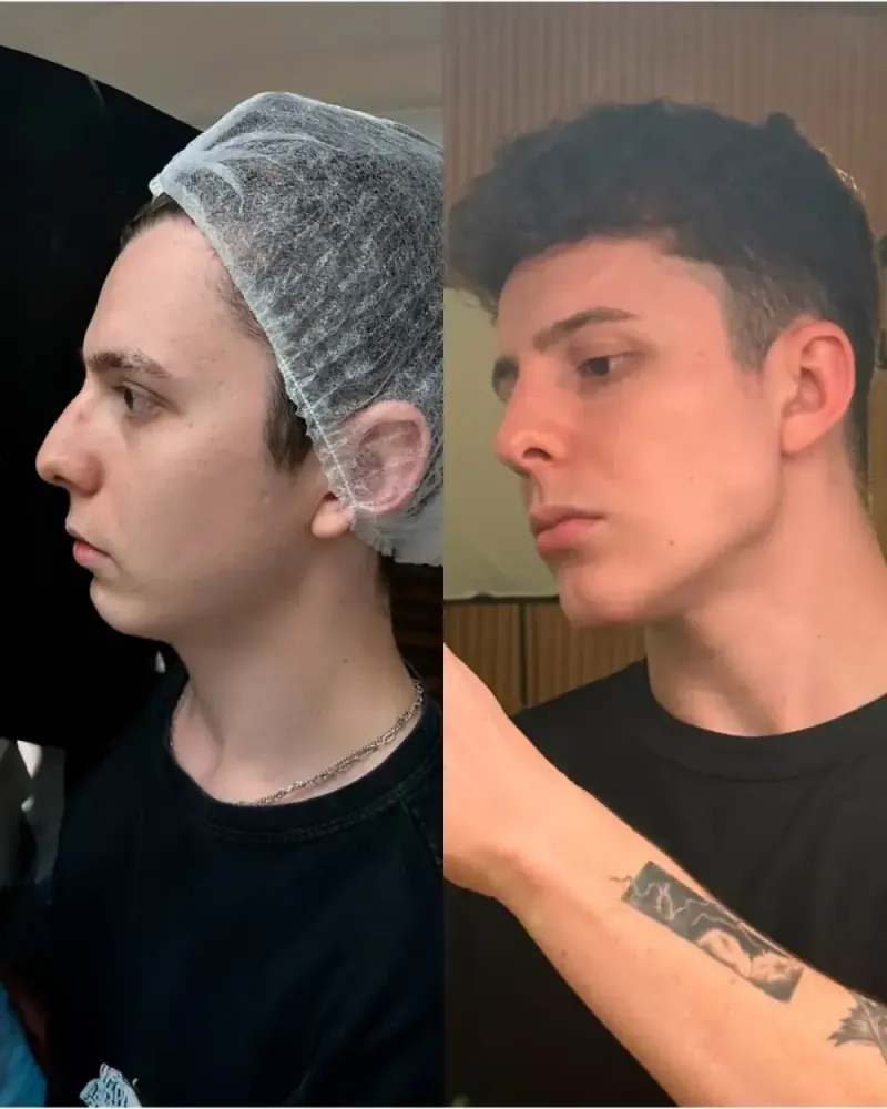 Caso real de Full Face masculino — antes e depois Dra. Beatriz Leal, Barra da Tijuca