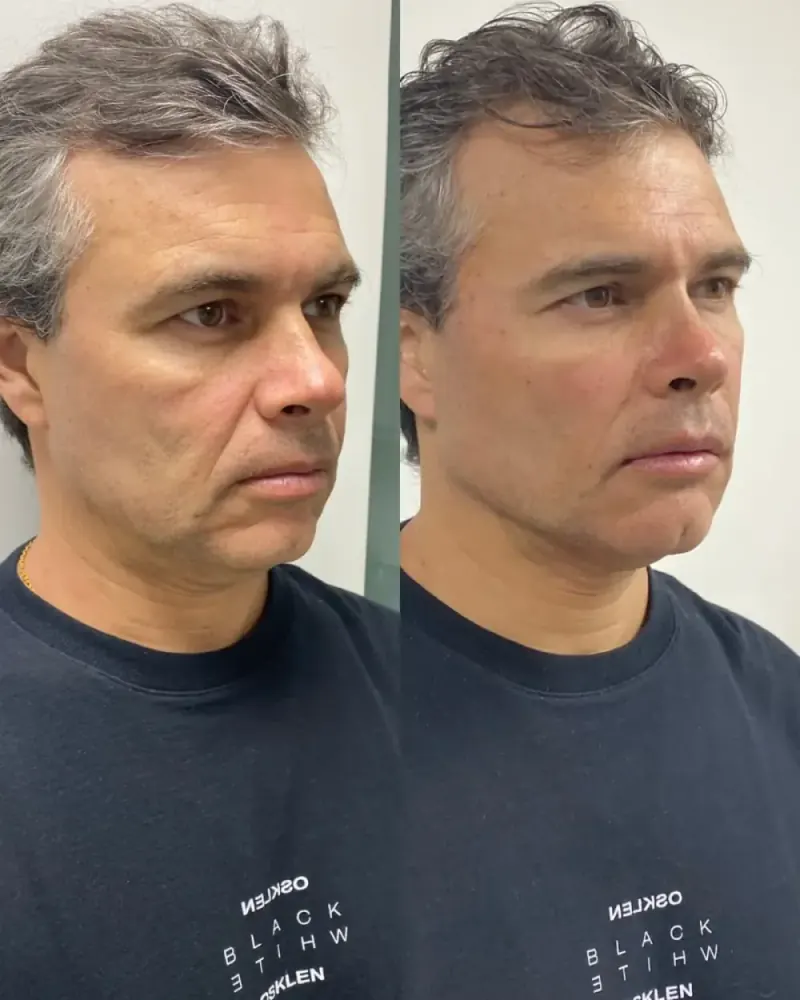 Caso real de Full Face masculino — harmonização facial Método Leal à Face para homens